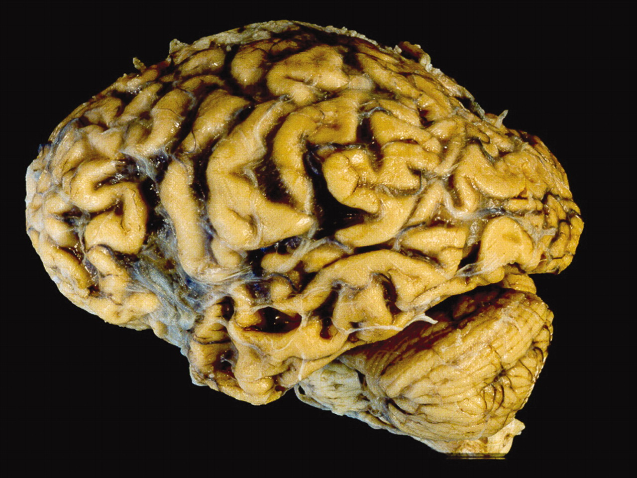 Атрофия вещества головного мозга. Дегенерация головного мозга. Деменция головного мозга.
